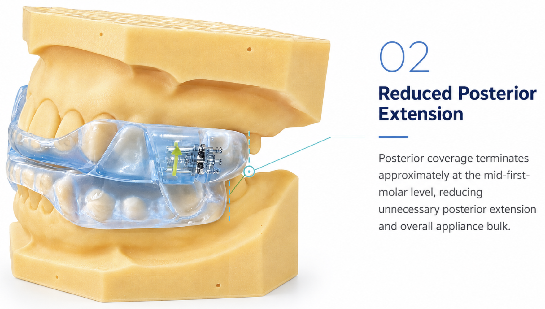 Master Sleep 20™ appliance — reduced posterior extension